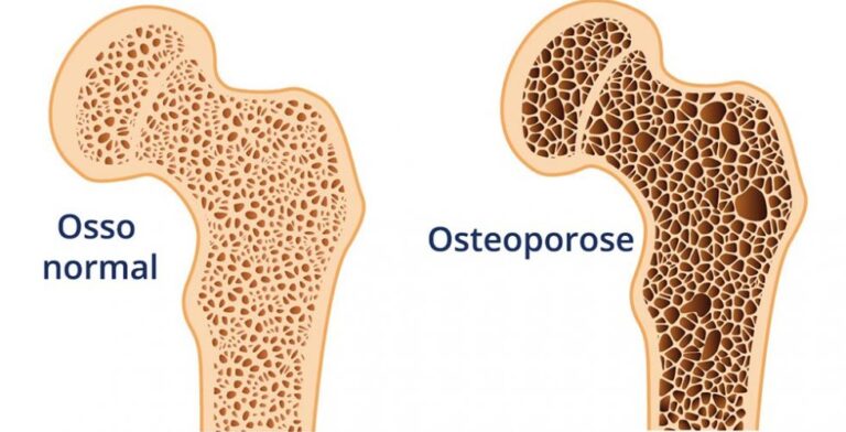 10 Coisas que Você Precisa Saber Sobre a Osteoporose.
